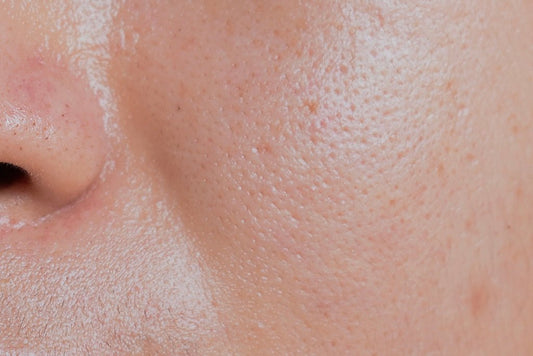 The Best Skincare Routine for Oily, Acne-Prone Skin