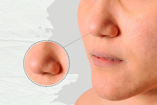 Dry White Patches on Skin: Should you be concerned?
