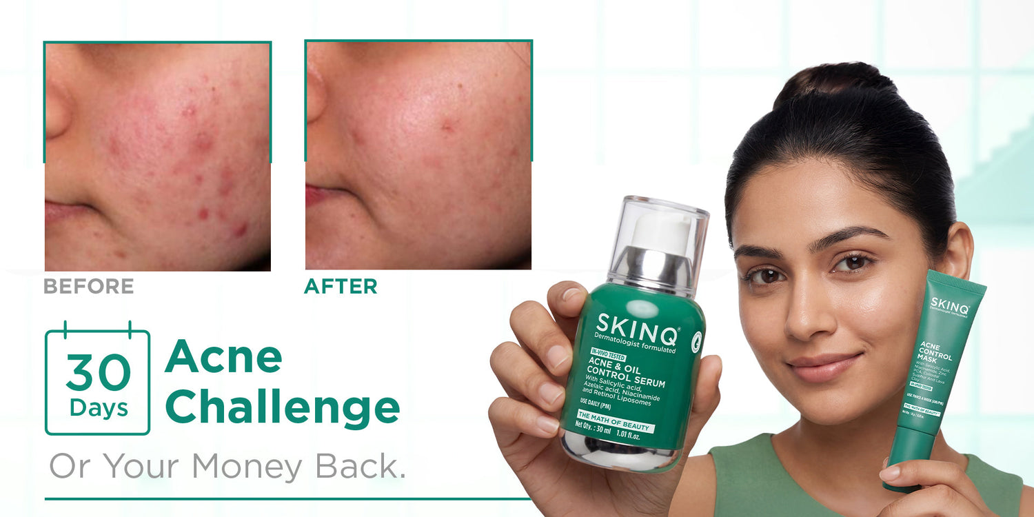 Acne- New