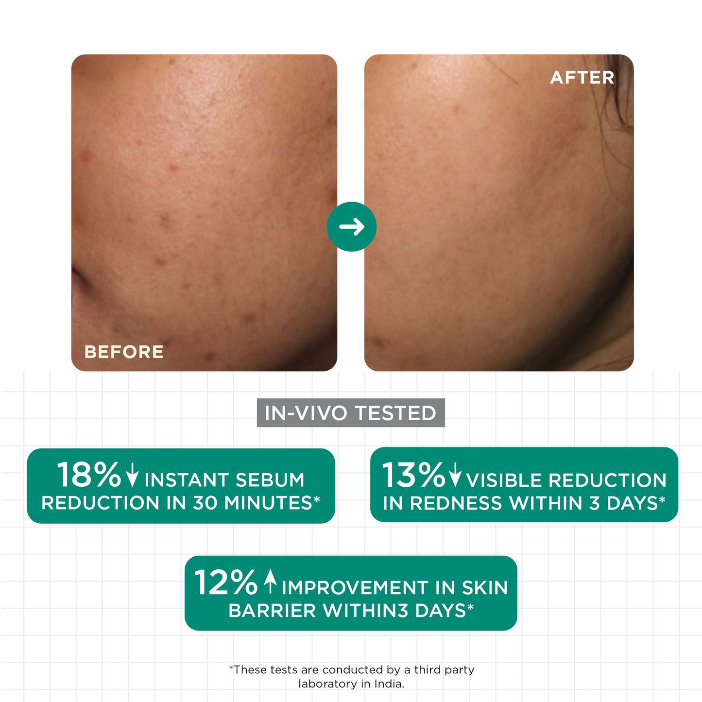 Acne & Oil Control Serum