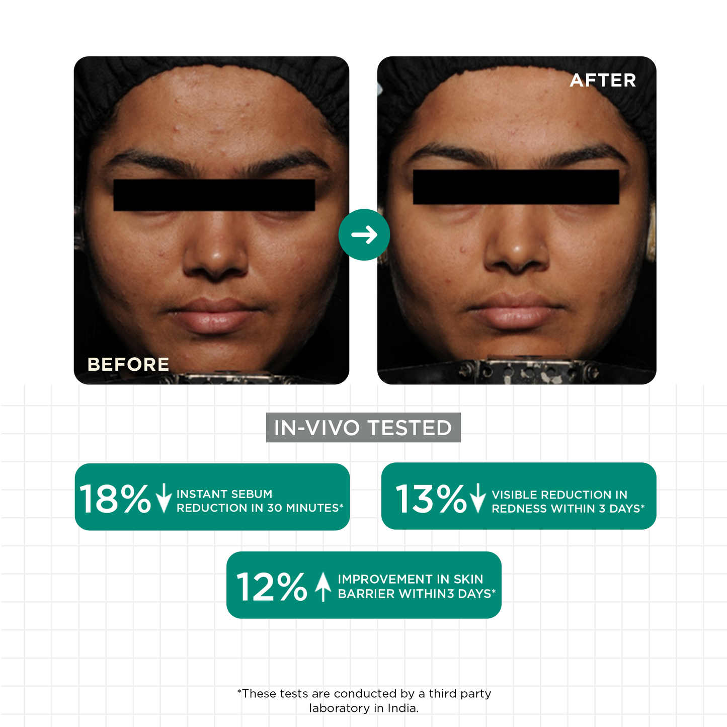 Acne & Oil Control Serum